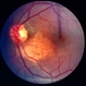 Choroidal osteoma case 1 no 2